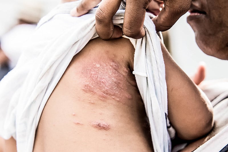 Atingidos apresentam diversos problemas de saúde, entre eles feridas e alergias na pele