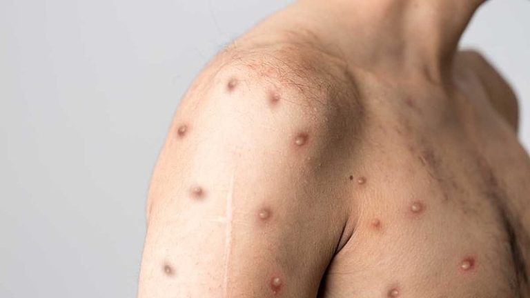 Casos de mpox registrados no RS em 2024 não são de variante que OMS colocou em nível de alerta